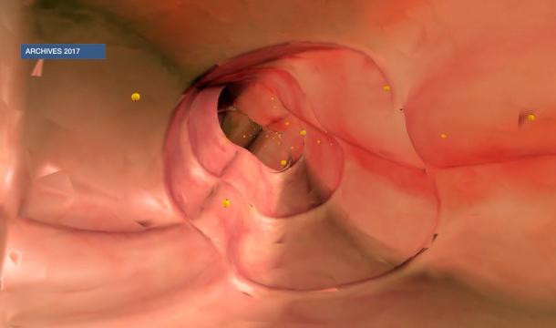 L'importance du dépistage du cancer colo-rectal !