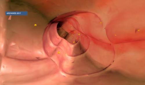 L'importance du dépistage du cancer colo-rectal !