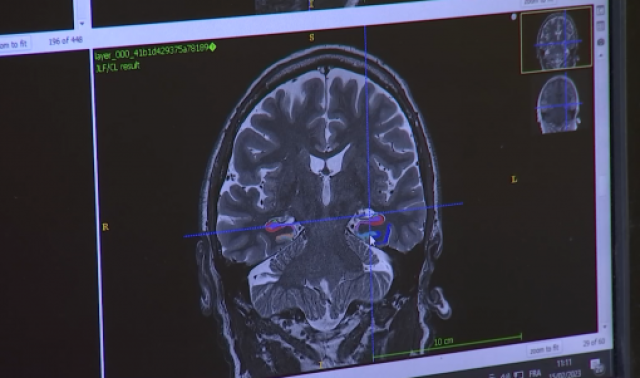 Les recherches de l'Université de Liège sur la maladie d'Alzheimer
